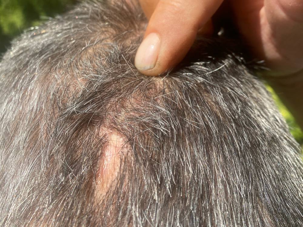 Close up of the back of a man's head with a finger pointing at a bald patch.