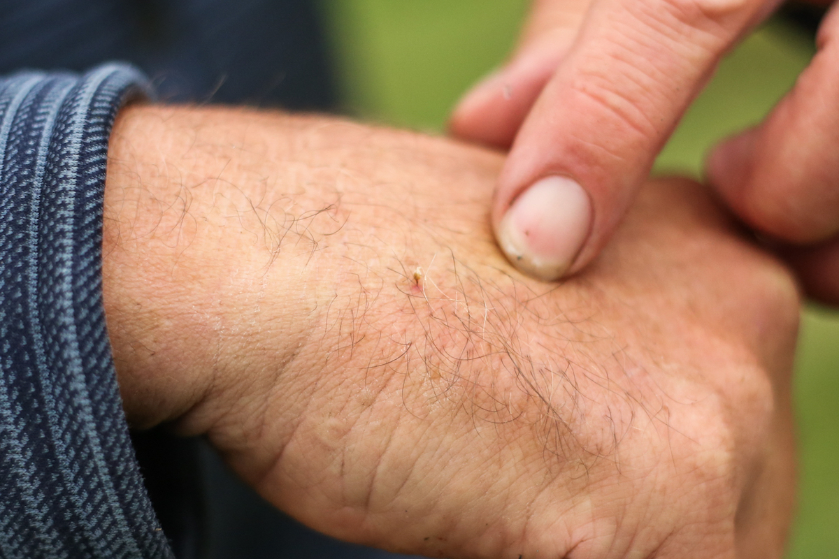 A close-up of a bee stinger stuck into the surface of a man’s skin.