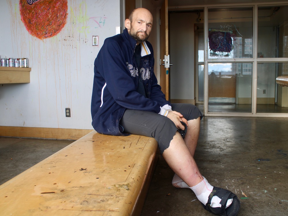 A man with thinning brown hair and close-cropped beard sits on a bench indoors. He is wearing a dark blue zip-up and grey pants cut off below the knee. His right leg and foot are visibly swollen and his right foot is wrapped in white gauze with a black brace over it.