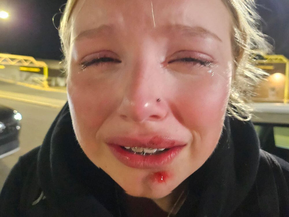 A young blond white woman is crying as she looks at the camera. She has nasty looking scrapes on her chin and upper lip.
