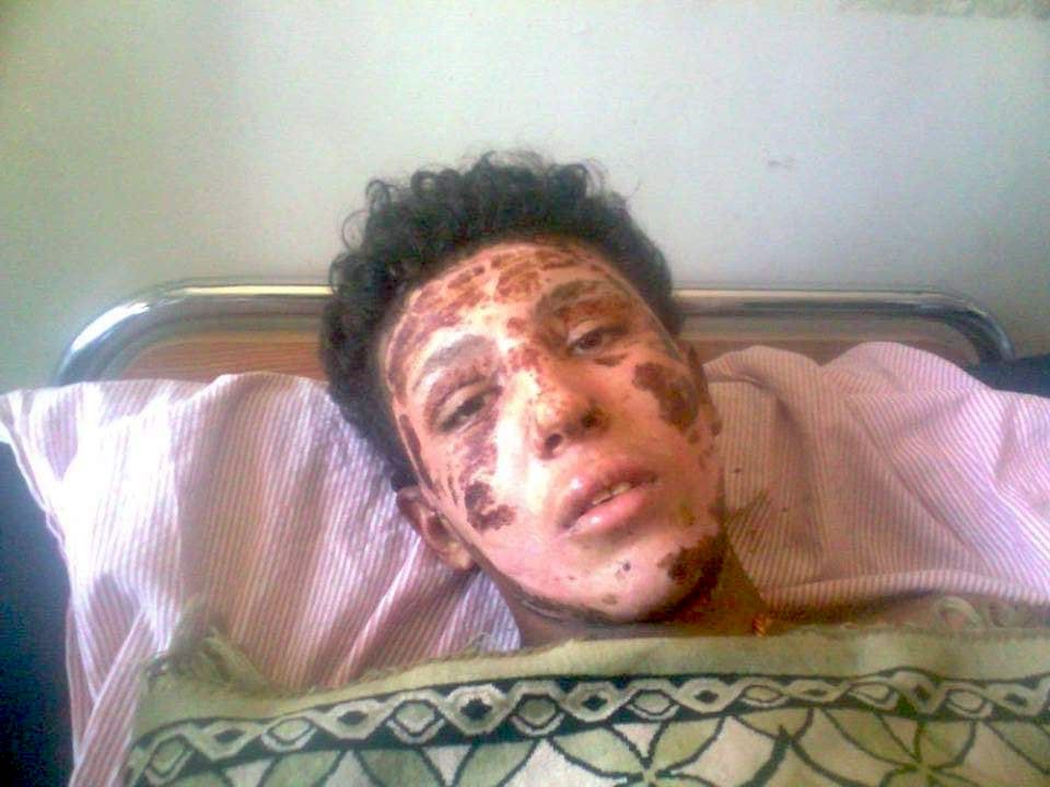 A teenage boy with dark, curly hair lies in a hospital bed. Darkened skin is peeling from his face.