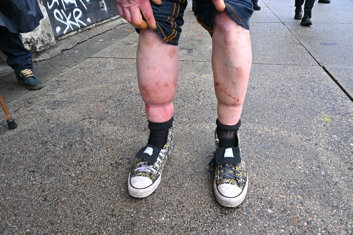 A photo of someone’s legs shows the right leg is swollen and looks a bit red and infected in one area.