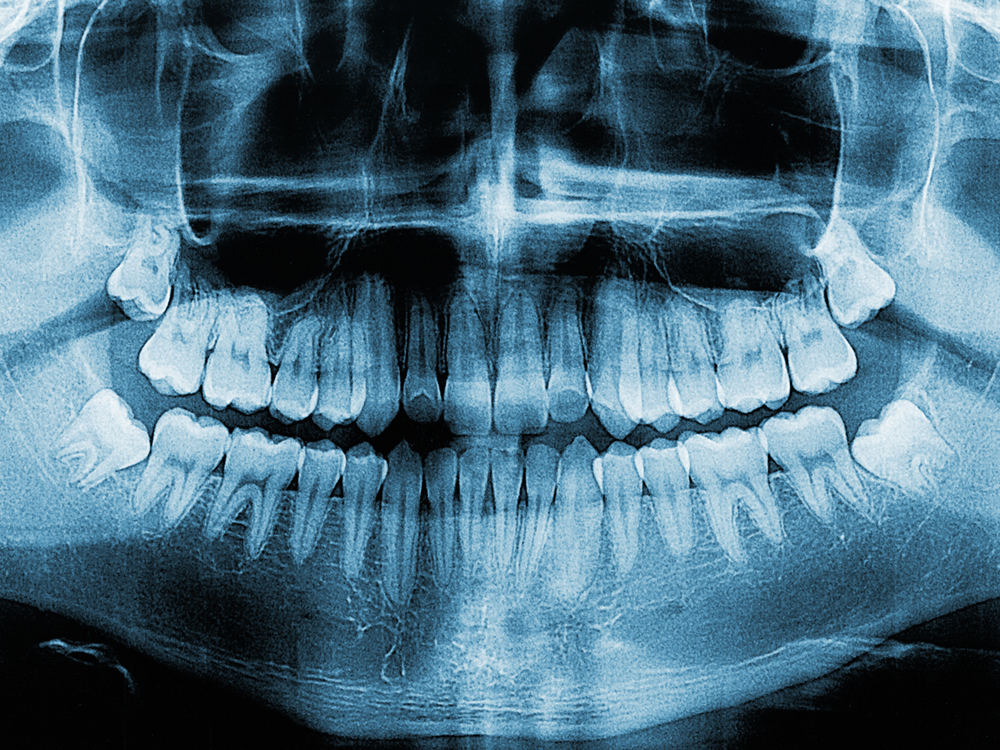 A dental X-ray. The person has several fillings.