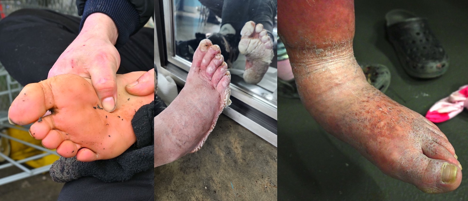 Left: a man rubs the sole of his foot. Middle: a man with water-soaked, white, wrinkled feet. Right: a woman’s foot has cellulitis.