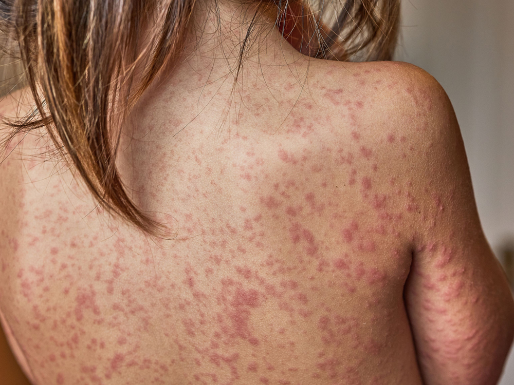 A young child with pale skin and light brown hair sits with their back to the camera. Their skin is covered in angry red spots, the tell-tail rash that comes with a measles infection.