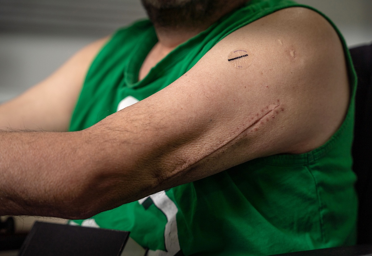 A close-up of the surgery scars on Francisco Barahona&rsquo;s arm.