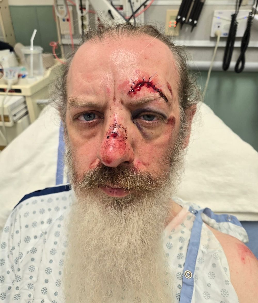 A man with light skin tone and a grey beard has large, stitched-up lacerations on his nose and over his eyebrow.