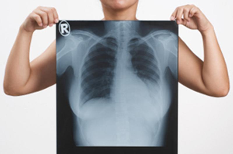 Breast X-Rays: The Pros and Cons May Surprise You